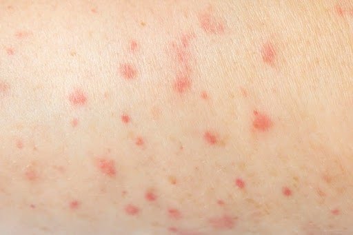 6. Irritações de pele 