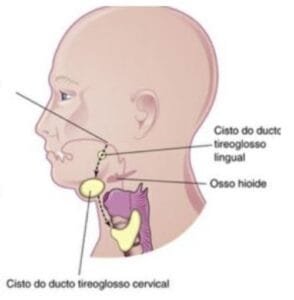 Inchaço no Pescoço: causas e o que fazer