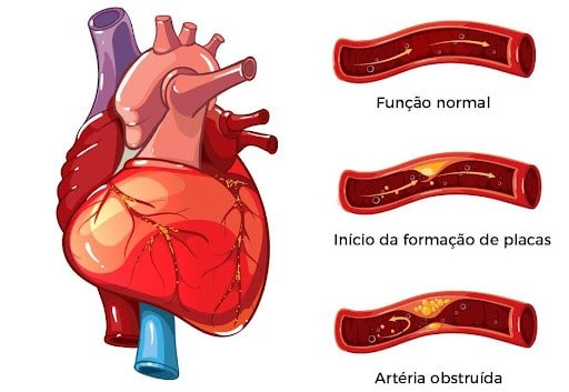 2. Patologias coronárias